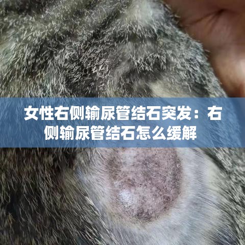 女性右側輸尿管結石突發:右側輸尿管結石怎么緩解