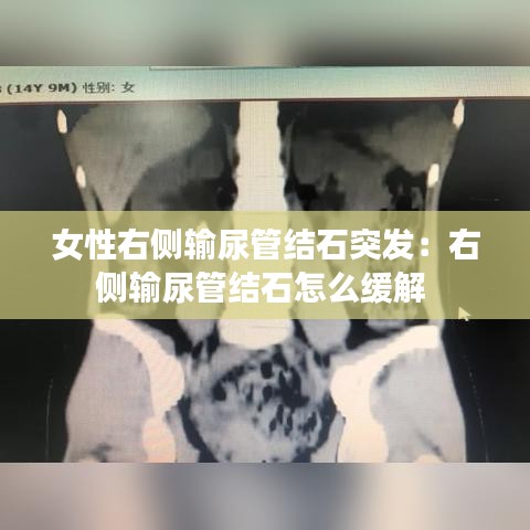 女性右側輸尿管結石突發:右側輸尿管結石怎么緩解