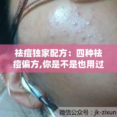 祛痘獨家配方：四種祛痘偏方,你是不是也用過 
