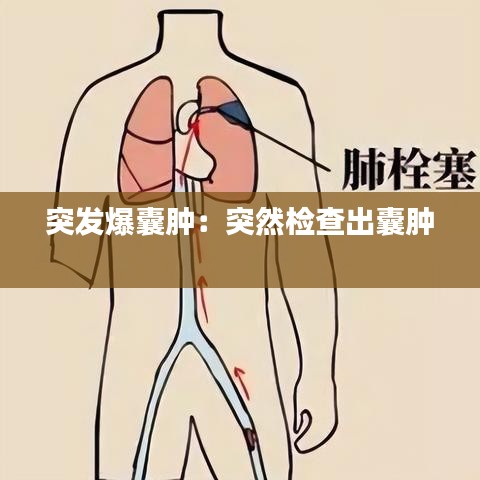 突發(fā)爆囊腫:突然檢查出囊腫