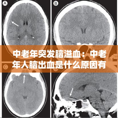中老年突發腦溢血:中老年人腦出血是什么原因有哪些