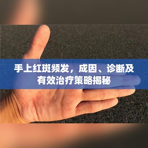 手上紅斑頻發(fā),成因、診斷及有效治療策略揭秘
