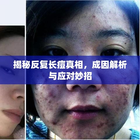 揭秘反復長痘真相,成因解析與應對妙招