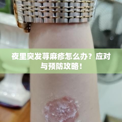 夜里突發蕁麻疹怎么辦?應對與預防攻略!
