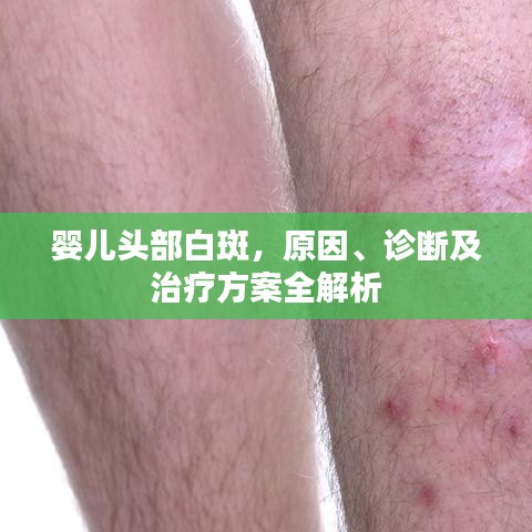 嬰兒頭部白斑,原因、診斷及治療方案全解析