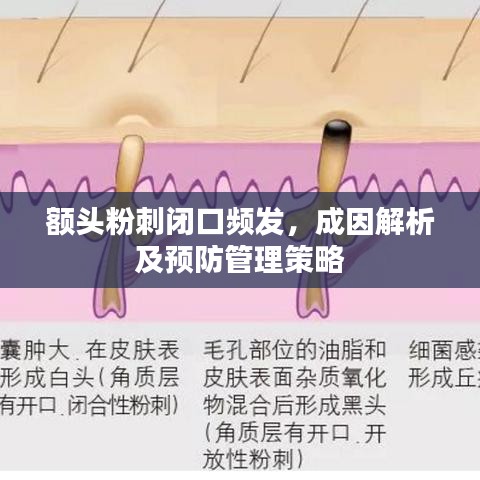 額頭粉刺閉口頻發，成因解析及預防管理策略