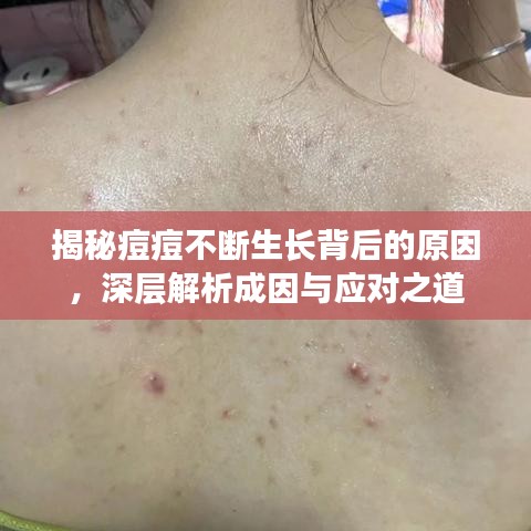 揭秘痘痘不斷生長(zhǎng)背后的原因,深層解析成因與應(yīng)對(duì)之道