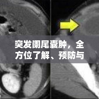 突發闌尾囊腫,全方位了解、預防與治療策略