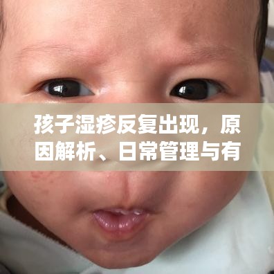 孩子濕疹反復出現,原因解析、日常管理與有效治療策略